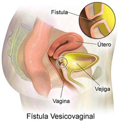 Vesicovaginal Fistula Surgery in India