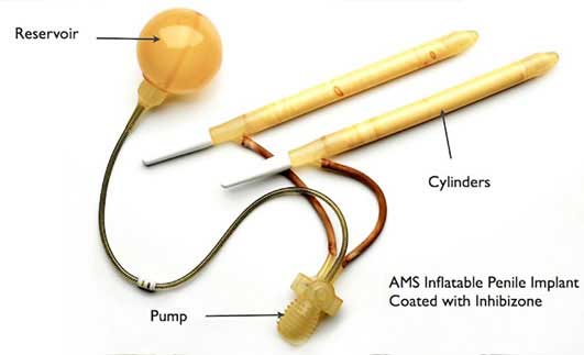 AMS 700 CX with InhibiZone – 3 piece Inflatable Penile Implant cost Surgery Hospital Mumbai, Chennai, Delhi, Kolkata, Hyderabad, Bangalore, Pune, Ahmedabad in India