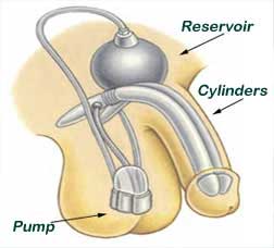 How Does the Penile Prosthesis Work Treatment in India