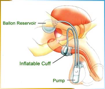 Artificial Urinary Sphincter Surgery in India