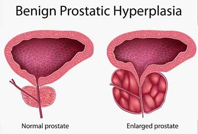 Benign prostatic hyperplasia treatment in india