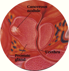 يصف سرطان البروستاتا المرحلة ب