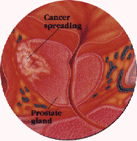 يصف سرطان البروستاتا المرحلة ج