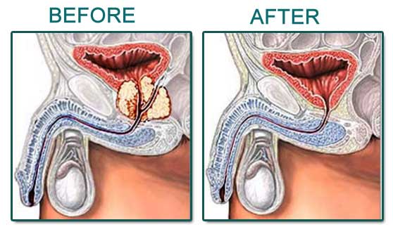 prostate gland surgery cost in india)