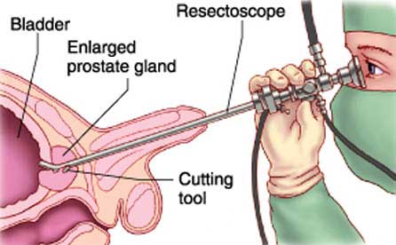 Transurethral Resection of Prostate (TRUP) in India