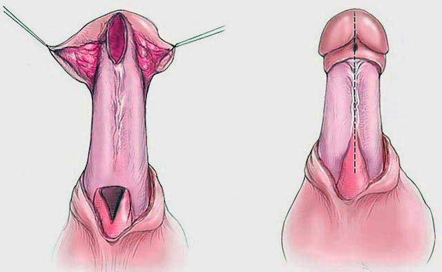 Urethroplasty Surgery in India