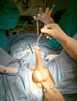 Urethroplasty procedure Anastomotic Technique in India