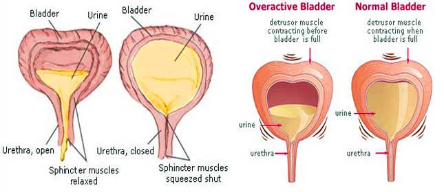 Urinary Incontinence Cost Treatment Surgery in Mumbai Chennai Delhi Kolkata Hyderabad Bangalore Pune Ahmedabad India