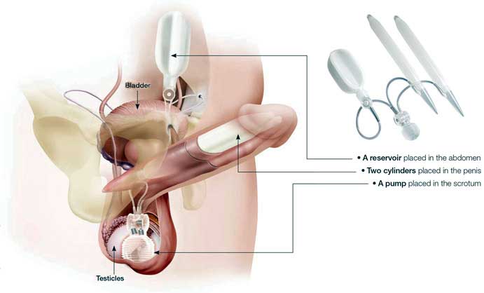 Coloplat Titan OTR – 3 piece Inflatable Penile Implant India cost Surgery Hospital Mumbai, Chennai, Delhi, Kolkata, Hyderabad, Bangalore, Pune, Ahmedabad in India