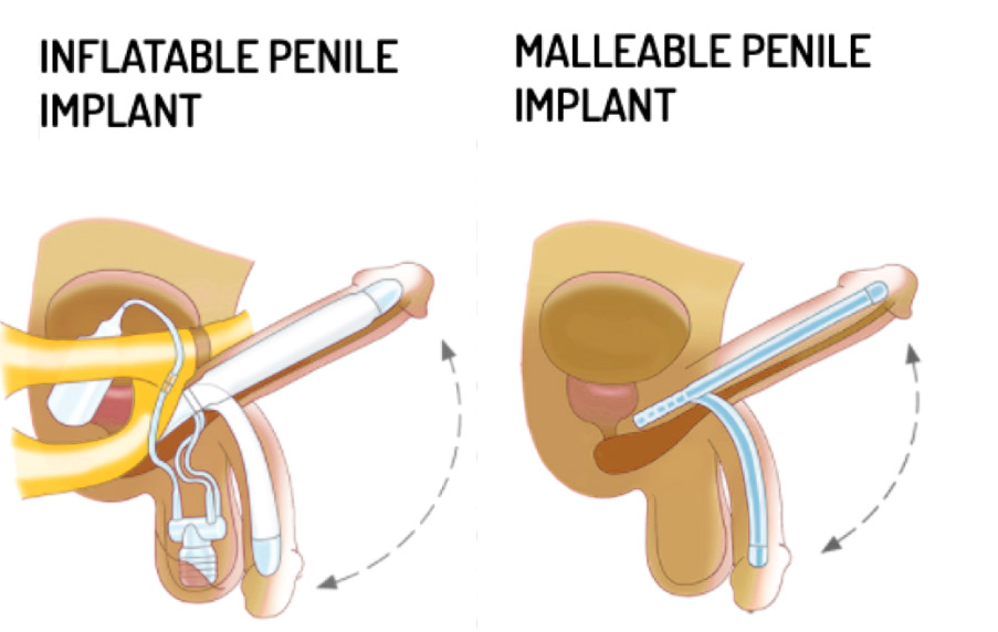 العلاج في الهند Medical Tourism in India - Get the best silicone