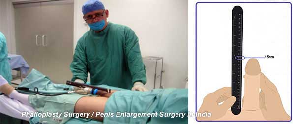 Phalloplasty, Penis Enlargement Surgery Cost in Mumbai Chennai Delhi Kolkata Hyderabad Bangalore Pune Ahmedabad India جراحة رأب القضيب في الهند