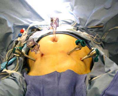 Robotic laparoscopies causes erectile dysfunction(ED)
